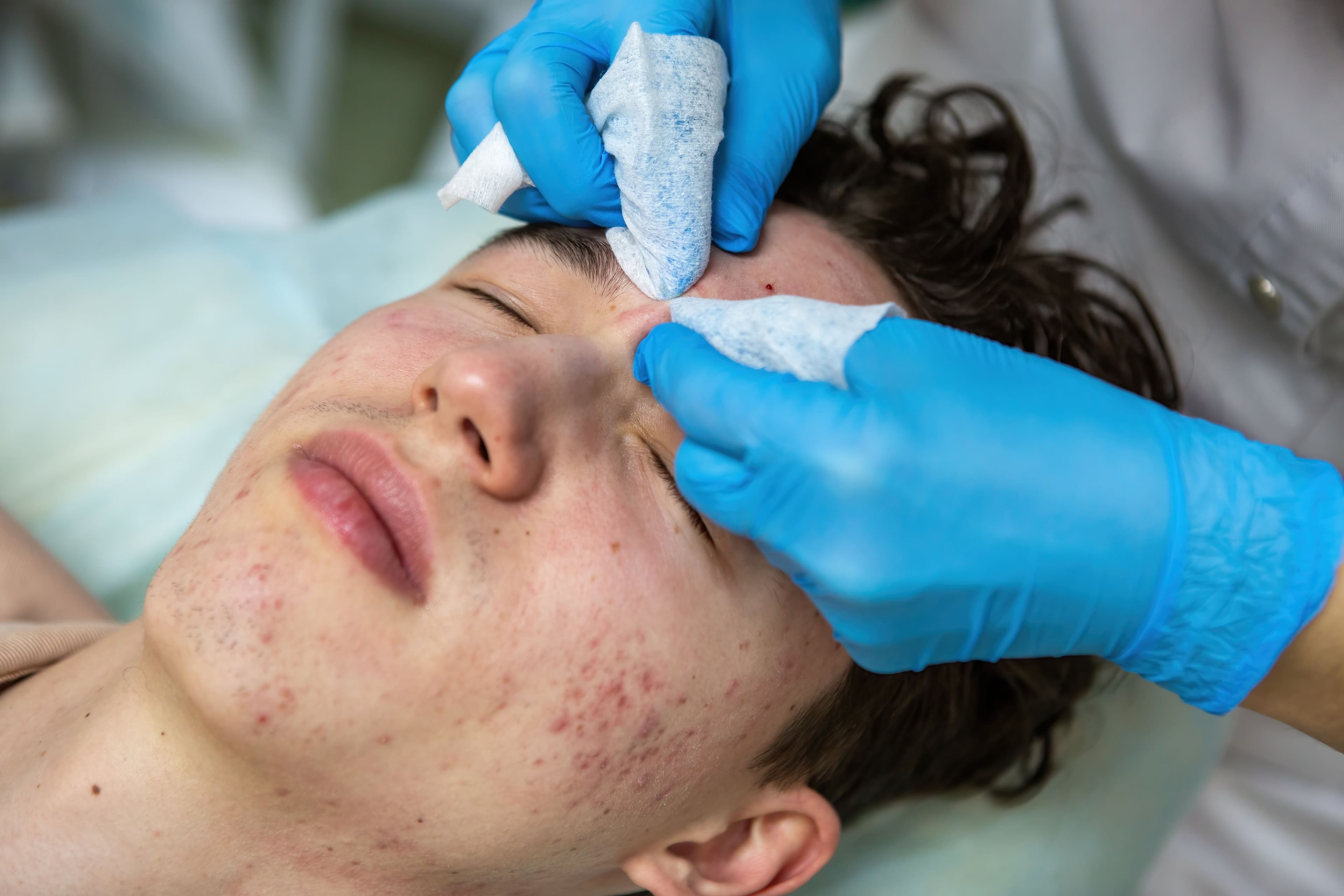 Diepte reiniging Acne